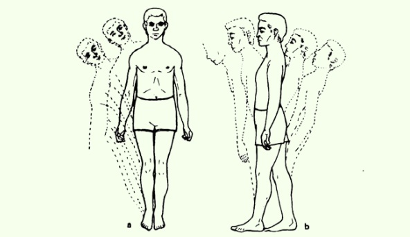 Romberg病 _ 眼瞼下垂を主訴に受診したParry-Romberg病の1例 – ORIL