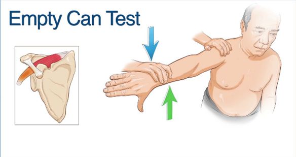 Teste Job Test de Jobe o Empty Can Test para Hombro - Explicación completa y ...
